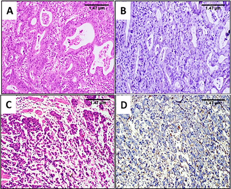 HER2 Oncogene Amplification and Immunohistochemical Profiling in Gastric Adenocarcinoma.