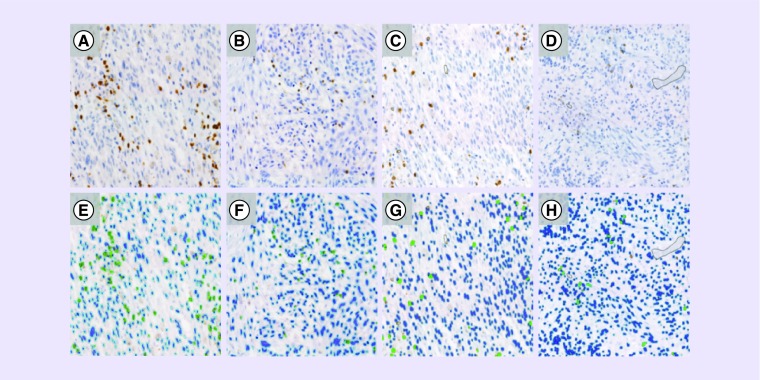 Distribution of tumor-infiltrating immune cells in glioblastoma.