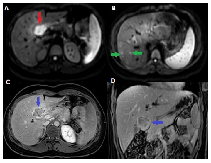 Tuberculosis (TB) of the Porta Hepatis Presenting with Obstructive Jaundice Mimicking a Malignant Biliary Tumor: A Case Report and Review of the Literature.