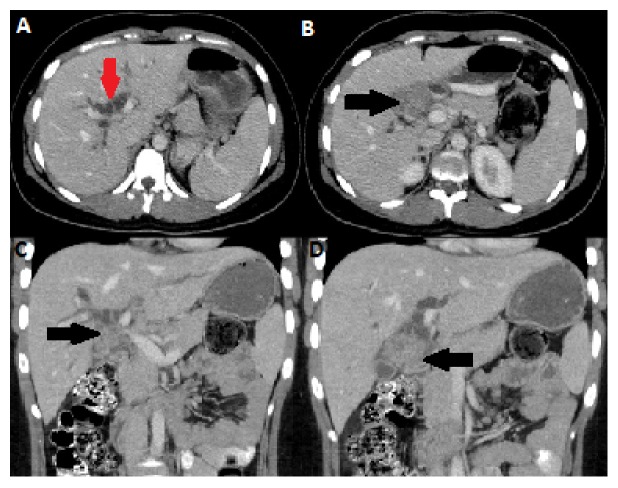 Tuberculosis (TB) of the Porta Hepatis Presenting with Obstructive Jaundice Mimicking a Malignant Biliary Tumor: A Case Report and Review of the Literature.