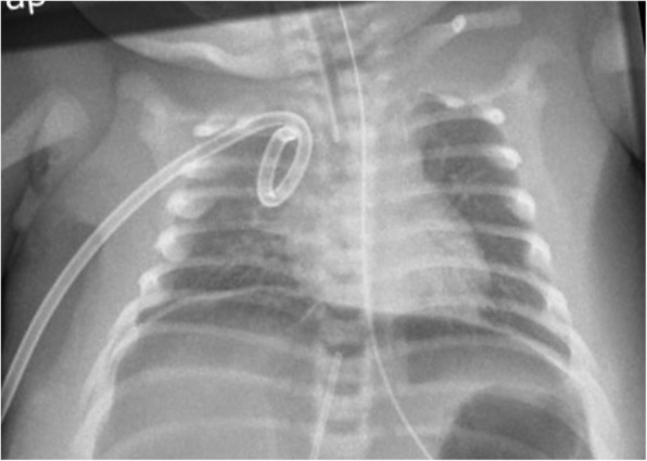 Successful treatment of severe arterial hypotension and anuria in a preterm infant with renal tubular dysgenesis- a case report.