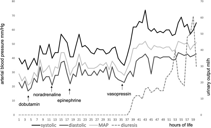 Successful treatment of severe arterial hypotension and anuria in a preterm infant with renal tubular dysgenesis- a case report.