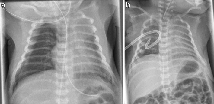 Successful treatment of severe arterial hypotension and anuria in a preterm infant with renal tubular dysgenesis- a case report.