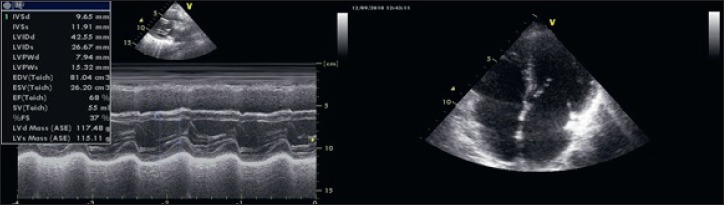 Heart transplantation in a patient with Myotonic Dystrophy type 1 and end-stage dilated cardiomyopathy: a short term follow-up.