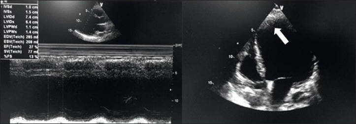 Heart transplantation in a patient with Myotonic Dystrophy type 1 and end-stage dilated cardiomyopathy: a short term follow-up.