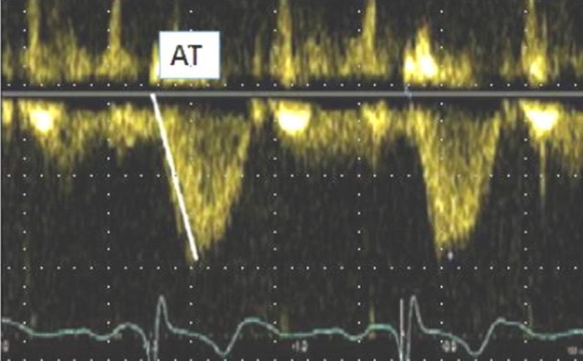 The improvement of right ventricular function after adenotonsillectomy in children with obstructive sleep apnea.