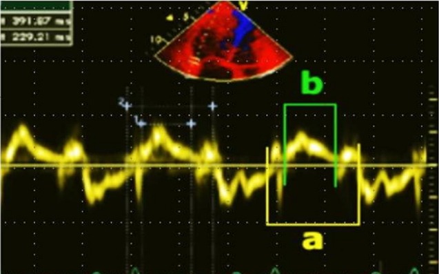 The improvement of right ventricular function after adenotonsillectomy in children with obstructive sleep apnea.