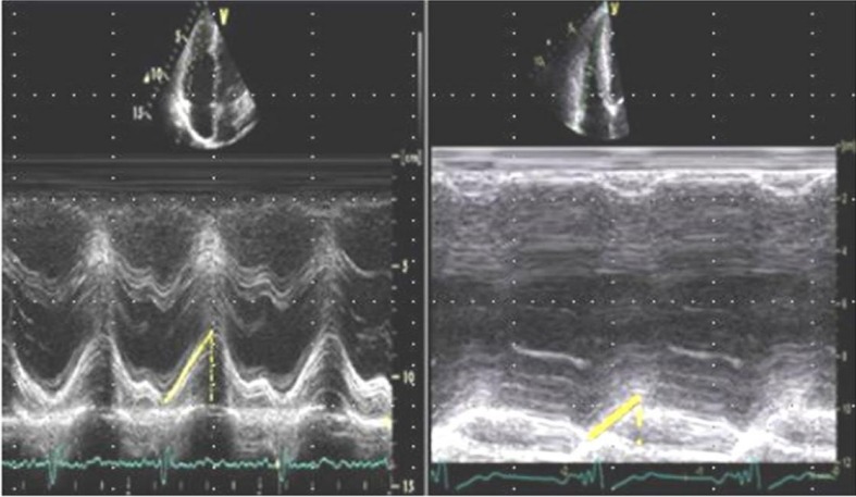 The improvement of right ventricular function after adenotonsillectomy in children with obstructive sleep apnea.