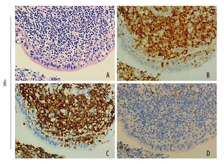 Retrospective Analysis of 9 Cases of Primary Pulmonary Mucosa-Associated Lymphoid Tissue Lymphoma and Literature Review.