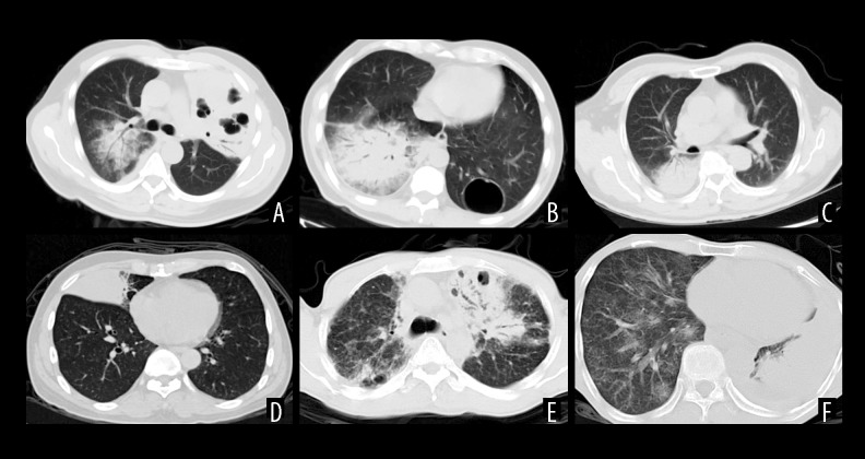 Retrospective Analysis of 9 Cases of Primary Pulmonary Mucosa-Associated Lymphoid Tissue Lymphoma and Literature Review.