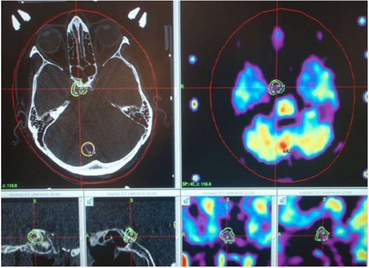 Radiosurgical techniques for the treatment of brain neoplasms: A short review.