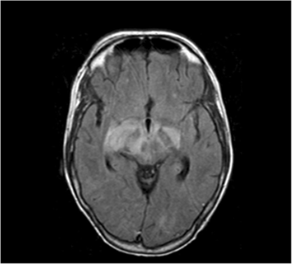 A case report of iatrogenic deterioration of yet undiagnosed Rhombencephalitis; always be careful with corticoids.