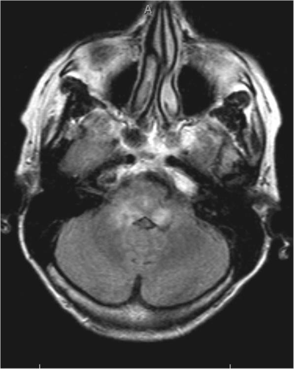 A case report of iatrogenic deterioration of yet undiagnosed Rhombencephalitis; always be careful with corticoids.