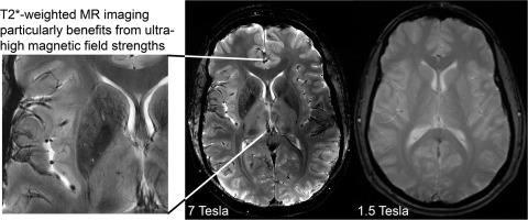 Pros and cons of ultra-high-field MRI/MRS for human application