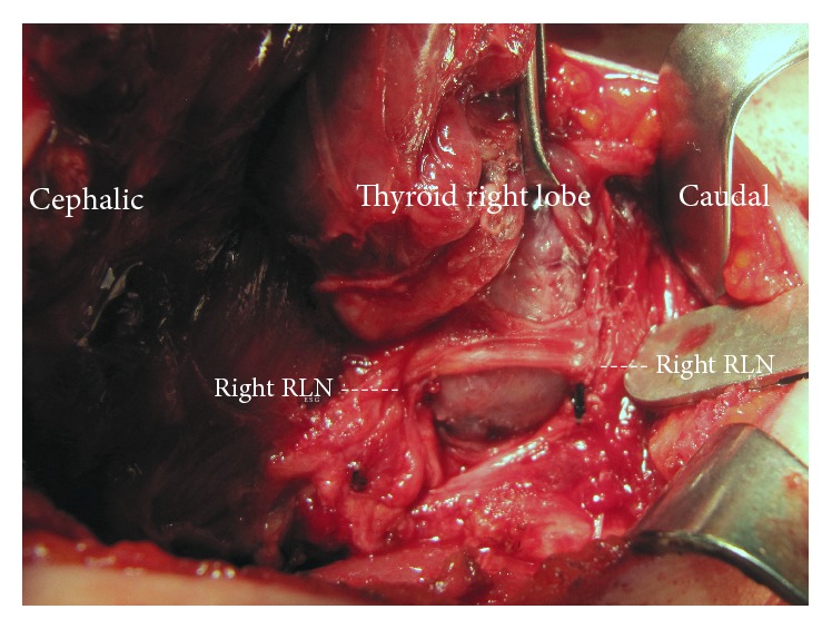 Displacement of the Recurrent Laryngeal Nerve in Patients with Recurrent Goiter Undergoing Redo Thyroid Surgery.