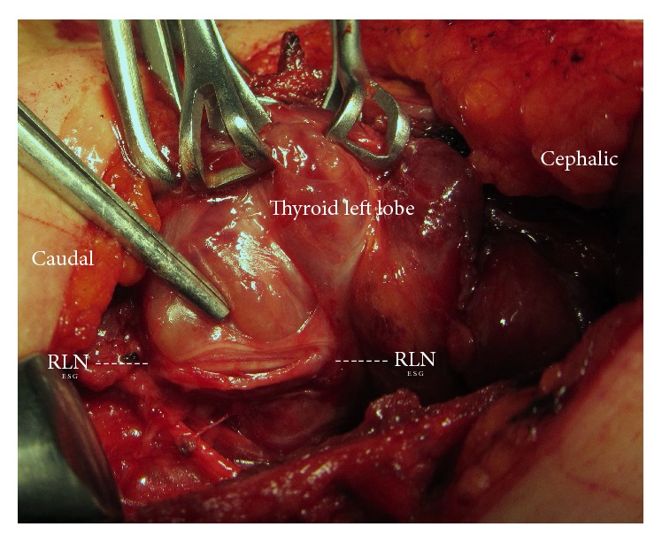 Displacement of the Recurrent Laryngeal Nerve in Patients with Recurrent Goiter Undergoing Redo Thyroid Surgery.