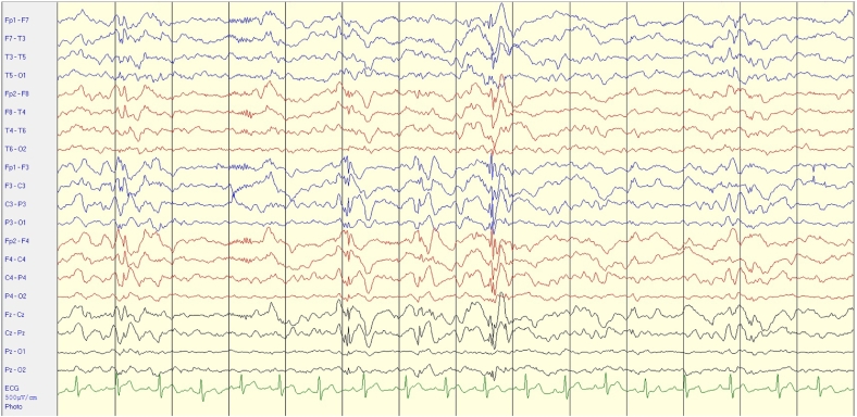 Lacosamide-induced excessive laughing in a patient with Lennox–Gastaut syndrome