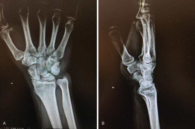 Locking Dorsal Plate in Four-Bone Arthrodesis in SLAC and SNAC 3 Wrist.