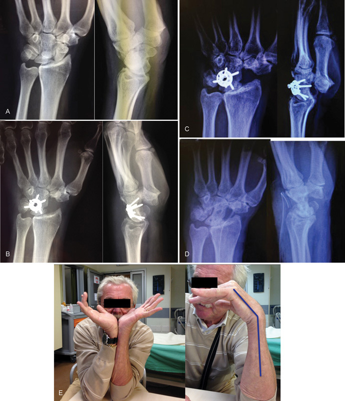 Locking Dorsal Plate in Four-Bone Arthrodesis in SLAC and SNAC 3 Wrist.