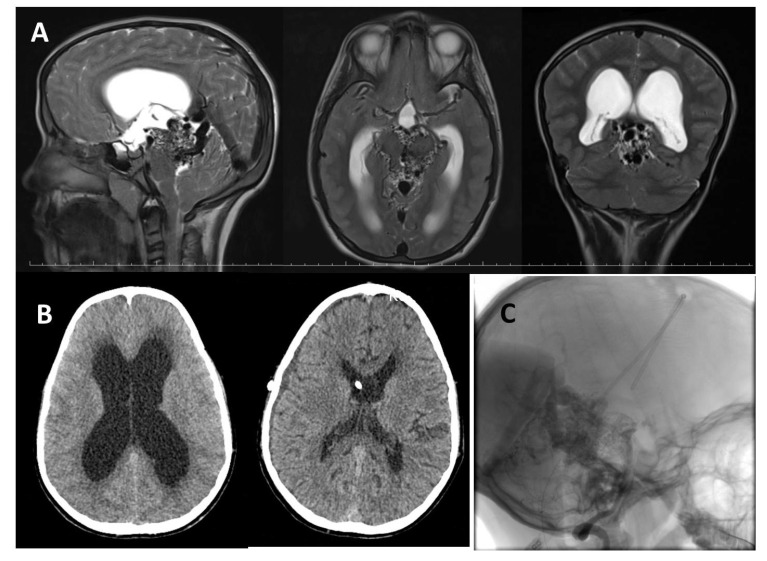 Case Report of an Obstructive Hydrocephalus Caused by an Unruptured Mesencephalic Arteriovenous Malformation in a Boy and a Review of Literature.