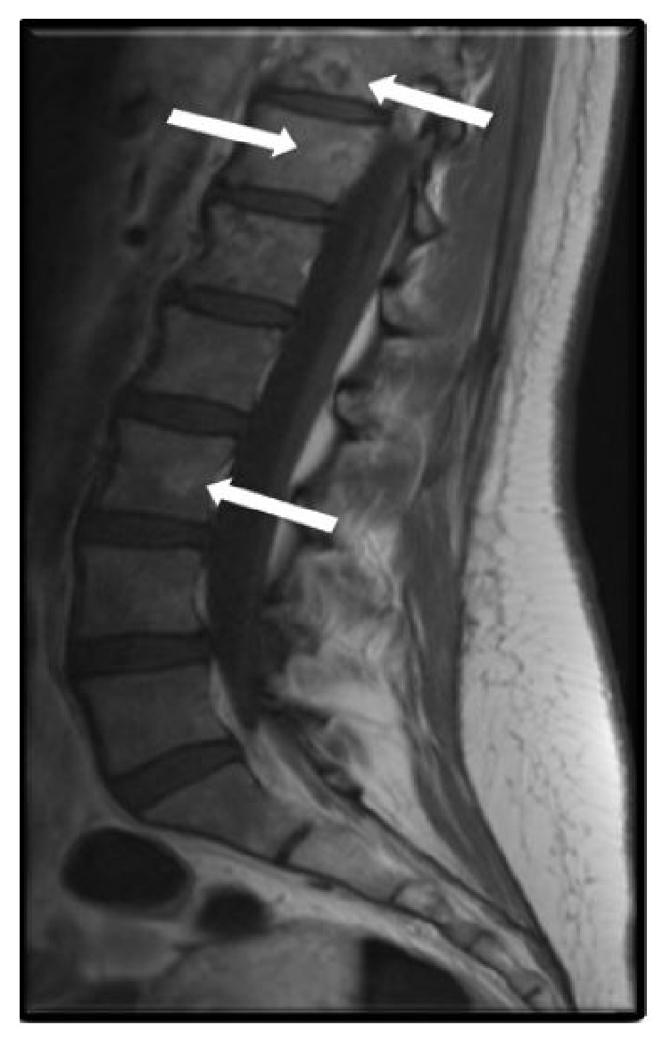 Effective Immunotherapy in Bone Marrow Metastatic Melanoma Presenting with Disseminated Intravascular Coagulopathy.