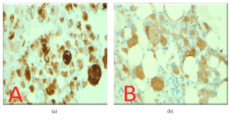 Effective Immunotherapy in Bone Marrow Metastatic Melanoma Presenting with Disseminated Intravascular Coagulopathy.