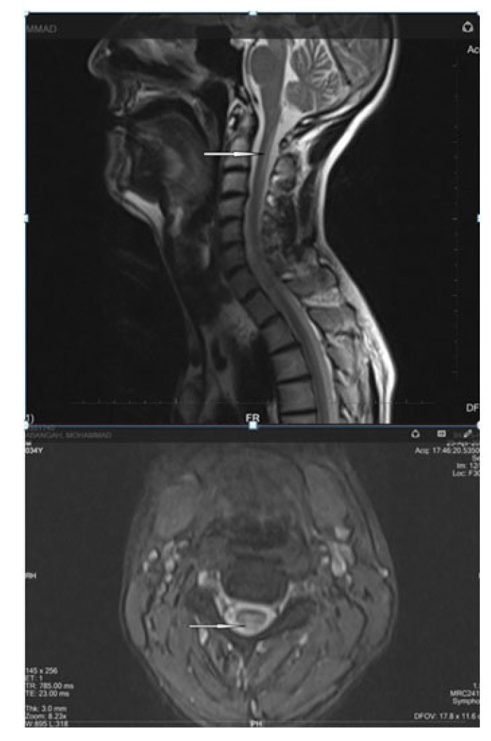 Vitamin B12 Deficiency as a Cause of Neurotrophic Keratopathy.