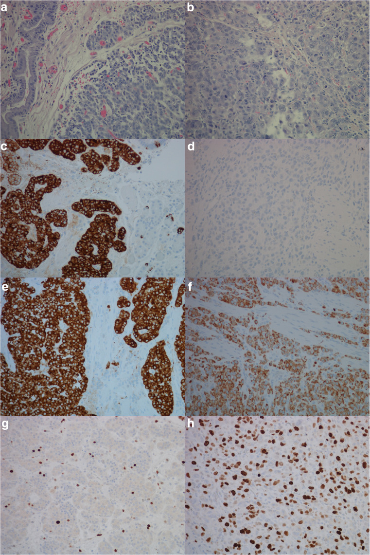 Expression of the Cholecystokinin-B Receptor in Neoplastic Gastric Cells.