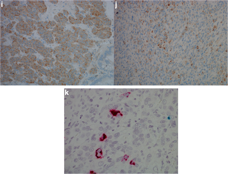 Expression of the Cholecystokinin-B Receptor in Neoplastic Gastric Cells.