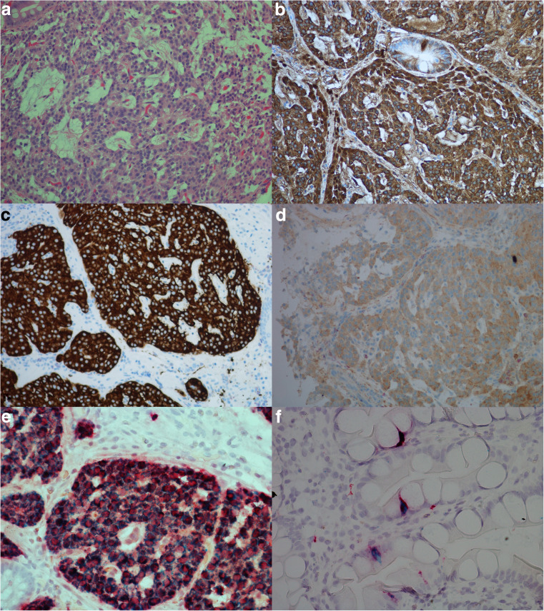 Expression of the Cholecystokinin-B Receptor in Neoplastic Gastric Cells.