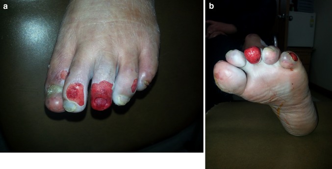 Secondary Raynaud's Phenomenon and Skin Necrosis of Toes in the Paraplegic Patient with Hypertension.