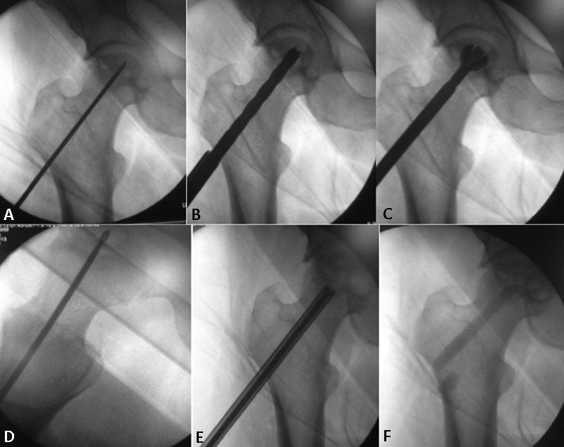 Survival Analysis after Core Decompression in Association with Platelet-Rich Plasma, Mesenchymal Stem Cells, and Synthetic Bone Graft in Patients with Osteonecrosis of the Femoral Head.