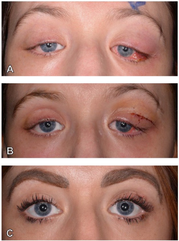 Orbital Inflammatory Complications of Crohn's Disease: A Rare Case Series.