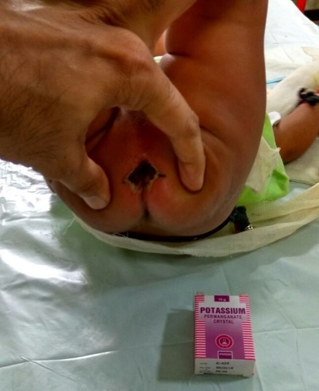 A Rare Case of Anal and Perianal Chemical Burn in a Child due to Potassium Permanganate Crystals.