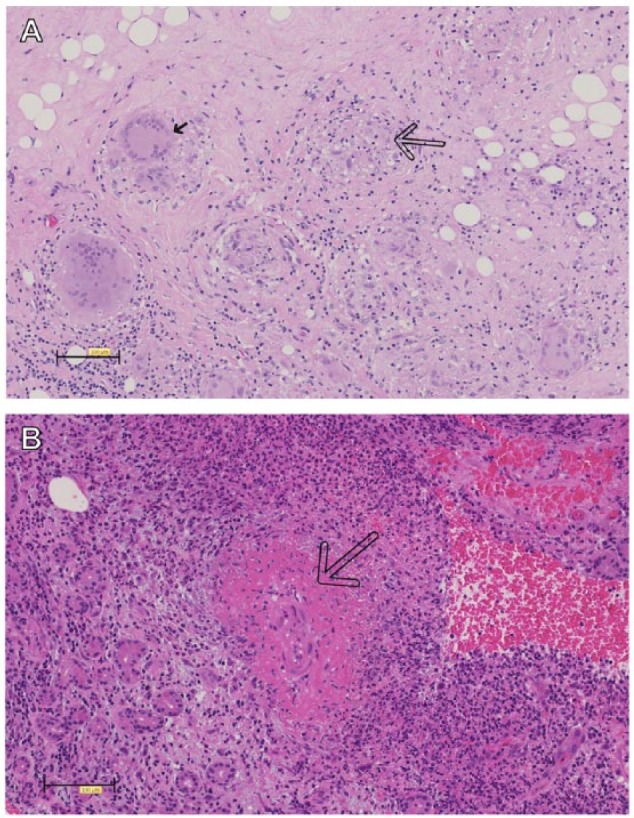 Orbital Inflammatory Complications of Crohn's Disease: A Rare Case Series.