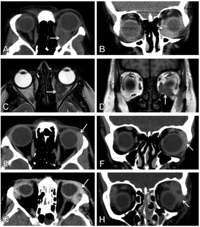 Orbital Inflammatory Complications of Crohn's Disease: A Rare Case Series.