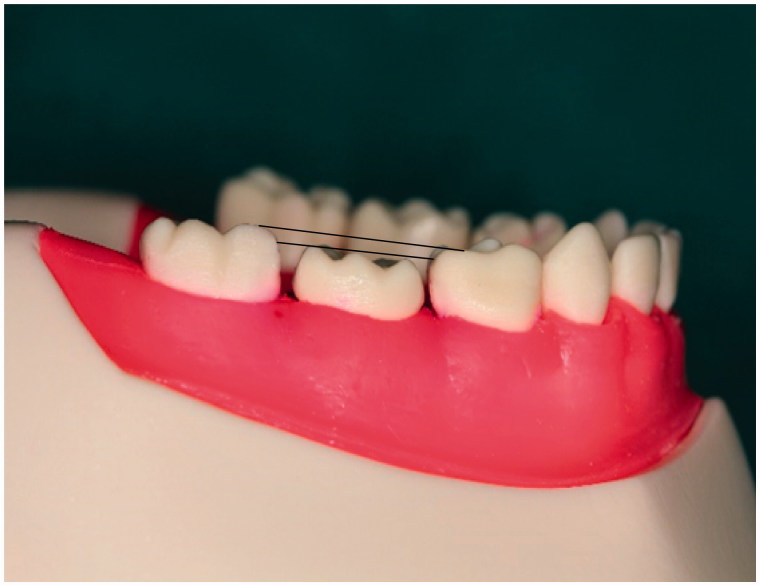 <i>In vitro</i> analysis of the marginal adaptation and discrepancy of stainless steel crowns.