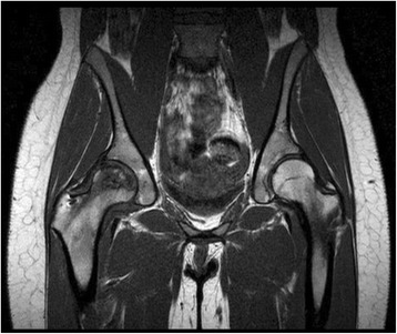 A rare case of avascular necrosis in sickle cell trait: a case report.