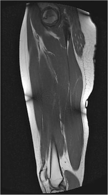 A rare case of avascular necrosis in sickle cell trait: a case report.