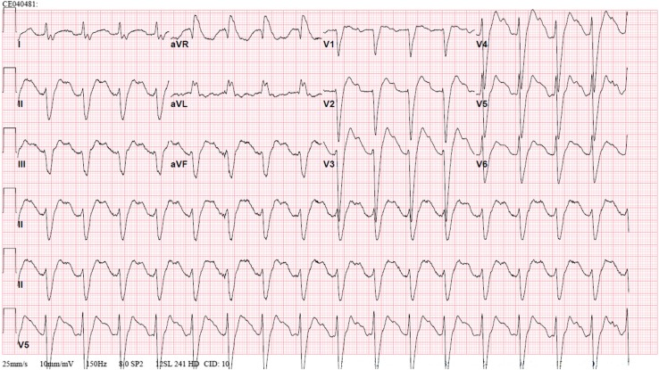 Ventricular Tachycardia Triggered by Loperamide and Famotidine Abuse.