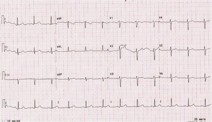 Ventricular Tachycardia Triggered by Loperamide and Famotidine Abuse.