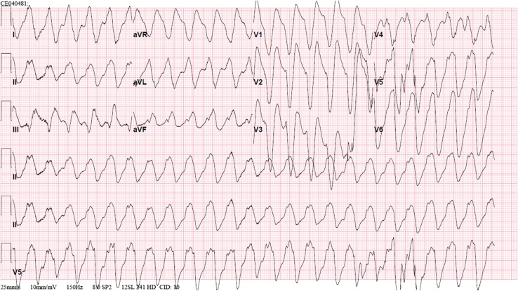 Ventricular Tachycardia Triggered by Loperamide and Famotidine Abuse.