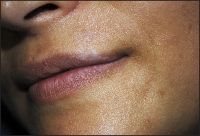 Lichen Sclerosus of the Upper Lip: Report of a Case, Utilizing Shikata's Modified Orcein Stain, and Review of the Literature.