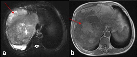 Primary hepatic neuroendocrine carcinoma: report of two cases and literature review.