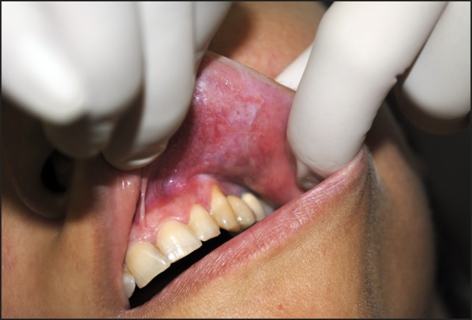 Lichen Sclerosus of the Upper Lip: Report of a Case, Utilizing Shikata's Modified Orcein Stain, and Review of the Literature.
