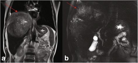 Primary hepatic neuroendocrine carcinoma: report of two cases and literature review.