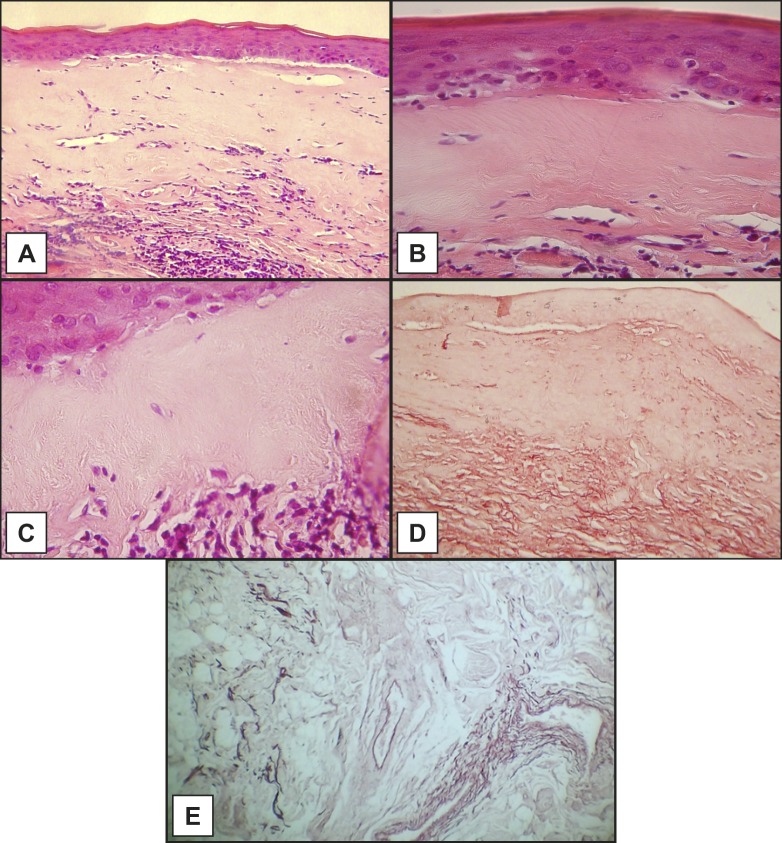 Lichen Sclerosus of the Upper Lip: Report of a Case, Utilizing Shikata's Modified Orcein Stain, and Review of the Literature.