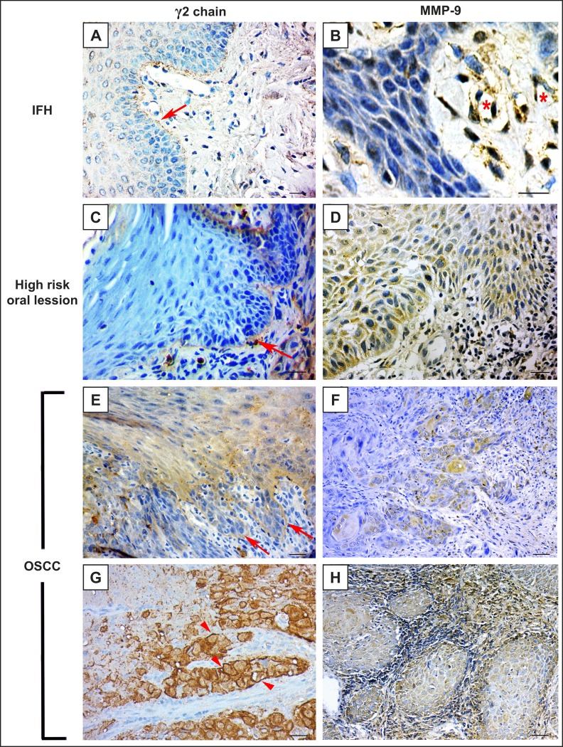 Immunohistochemical Study of Laminin-332 γ2 Chain and MMP-9 in High Risk of Malignant Transformation Oral Lesions and OSCC.