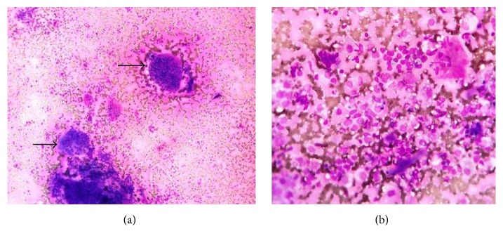 Cytomorphological Spectrum of Thyroiditis: A Review of 110 Cases.