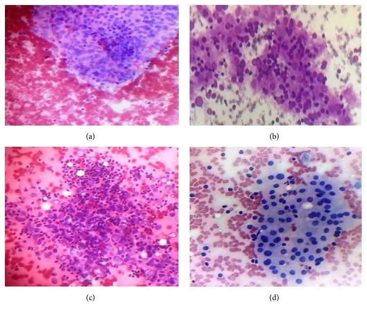 Cytomorphological Spectrum of Thyroiditis: A Review of 110 Cases.